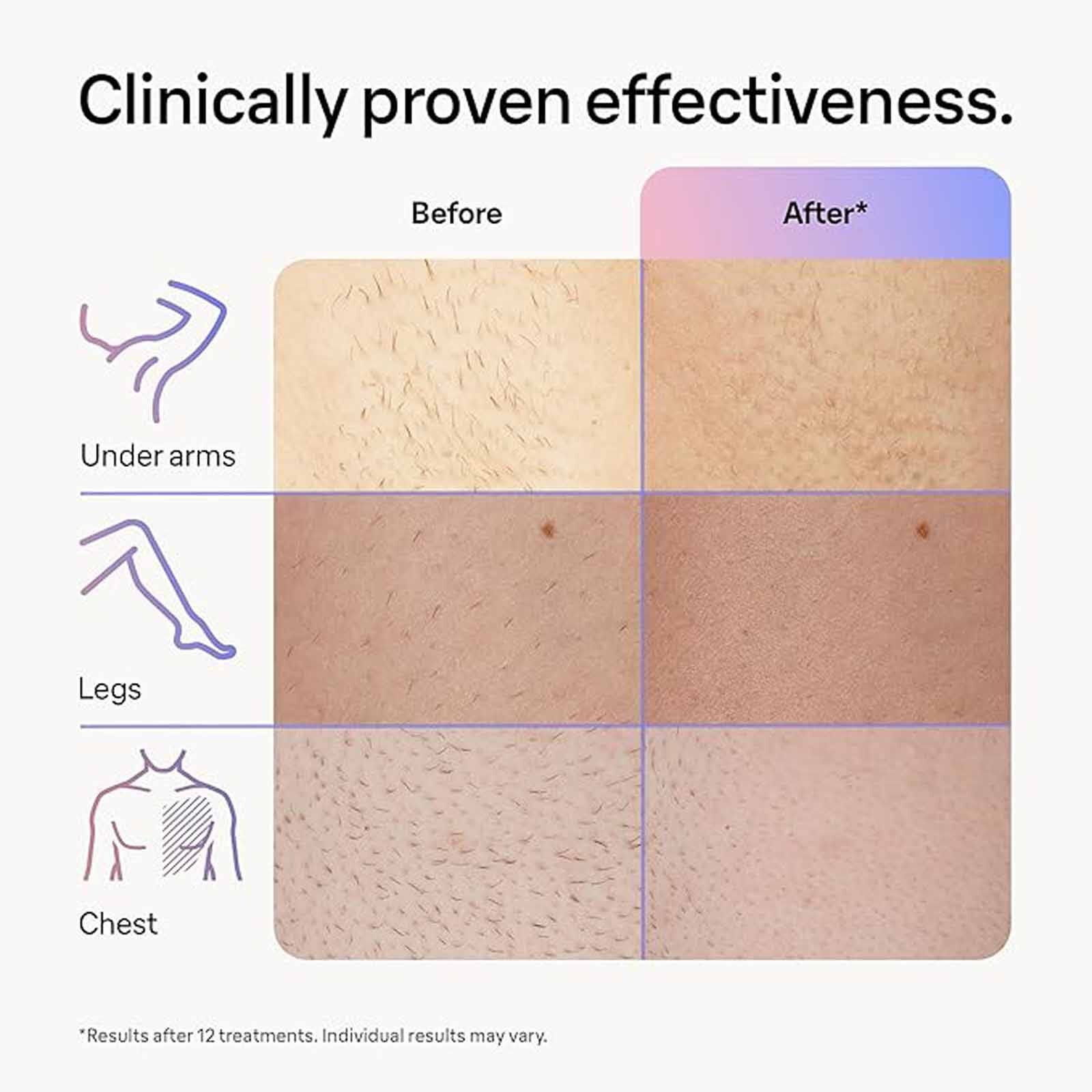 BRAUN Smart Ipl Skin I&middot;expert PL 7253-image 2